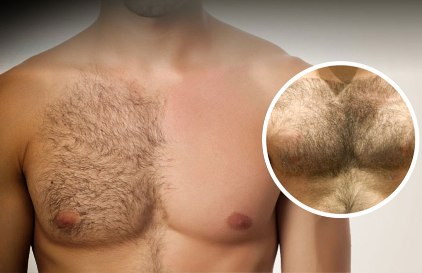 Body Hair Transplant