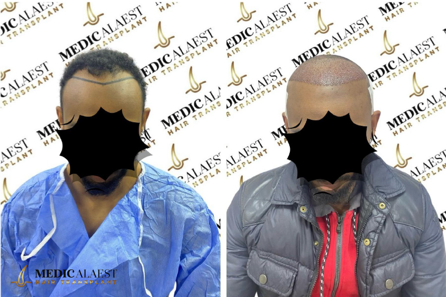 Medicalaest - AFRICAN HAIR TRANSPLANT