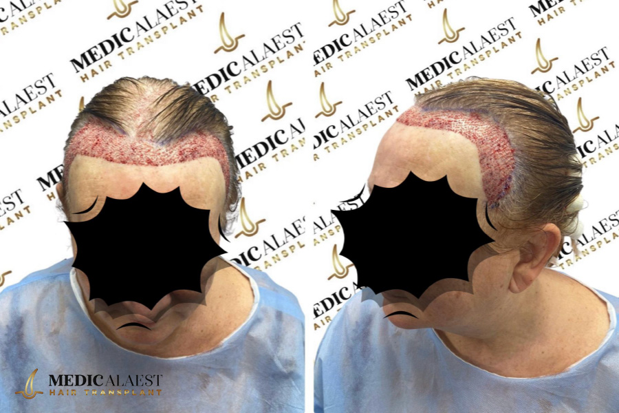 Medicalaest - FEMALE HAIR TRANSPLANT
