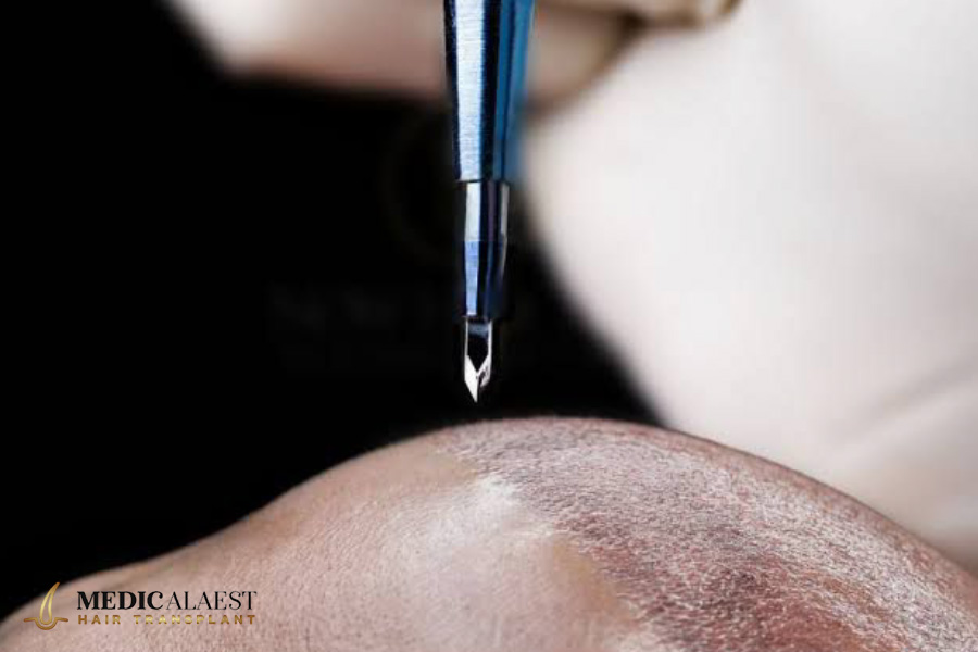 Medicalaest - FUE SAPHIR HAIR TRANSPLANT