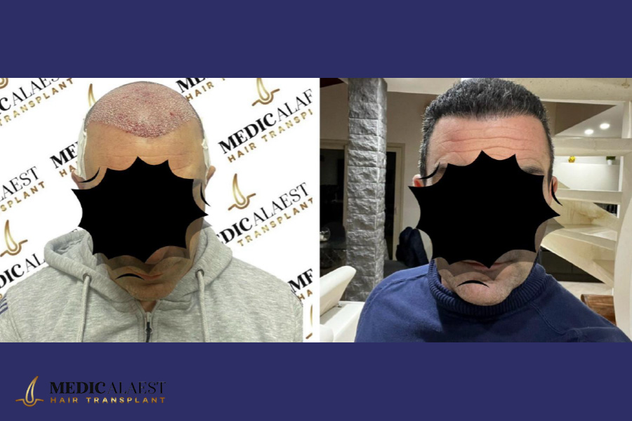 Medicalaest - HAIR LINE RESTORATION