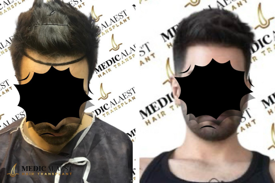 Medicalaest - HAIR LINE RESTORATION