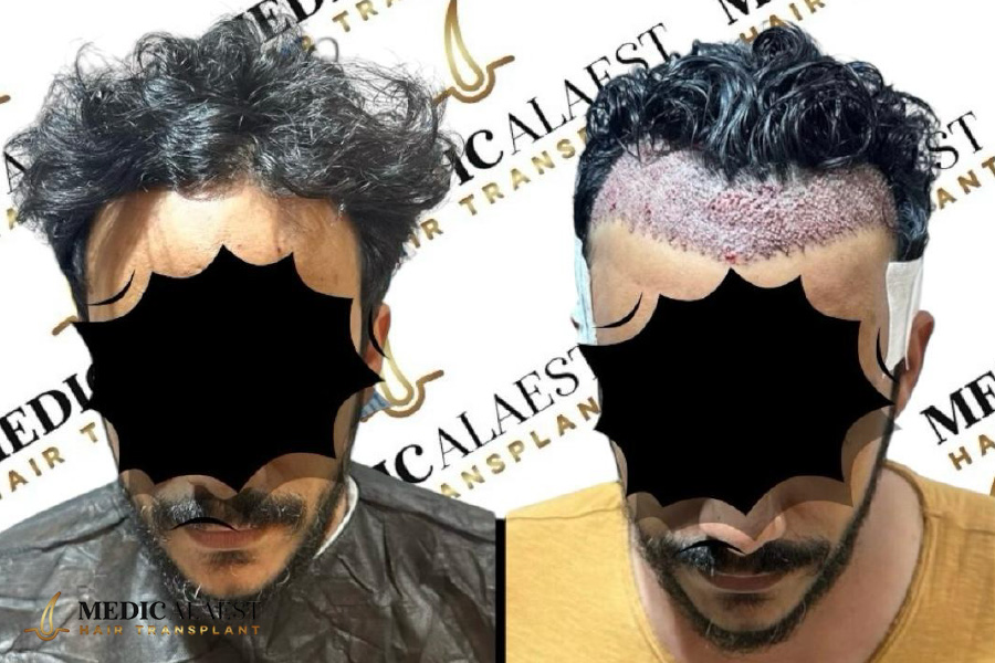 Medicalaest - NO-SHAVING HAIR TRANSPLANT