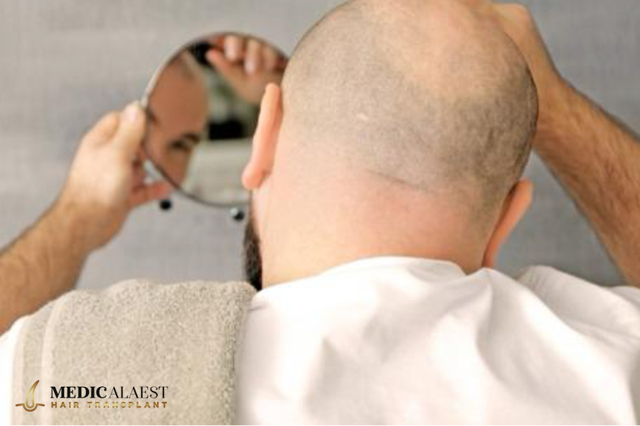 Medicalaest - PRP THERAPY FOR HAIR LOSS