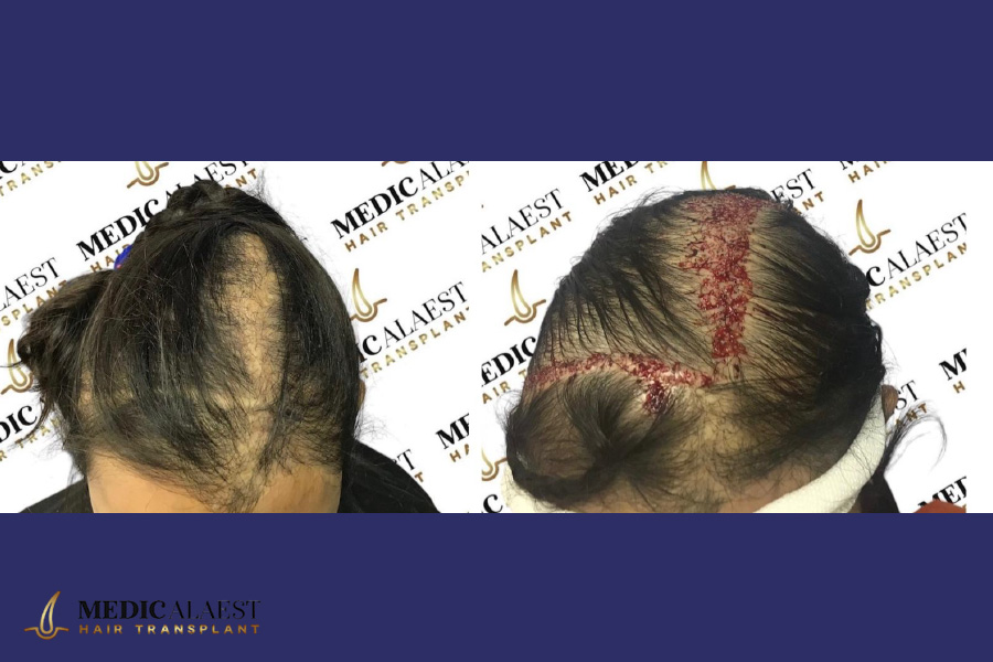 Medicalaest - SCAR TISSUE HAIR TRANSPLANT